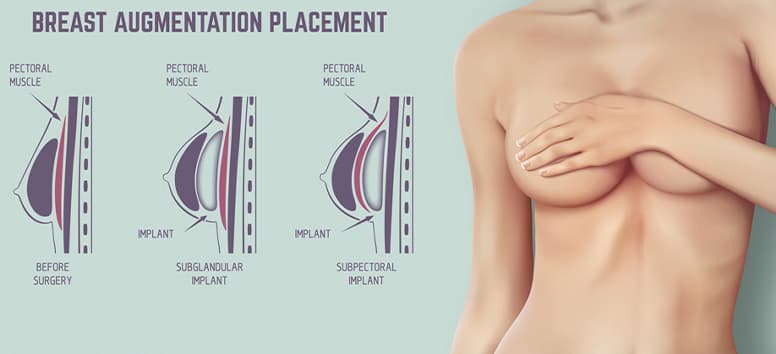 Breast Implants: A Step Towards Your Ideal Self